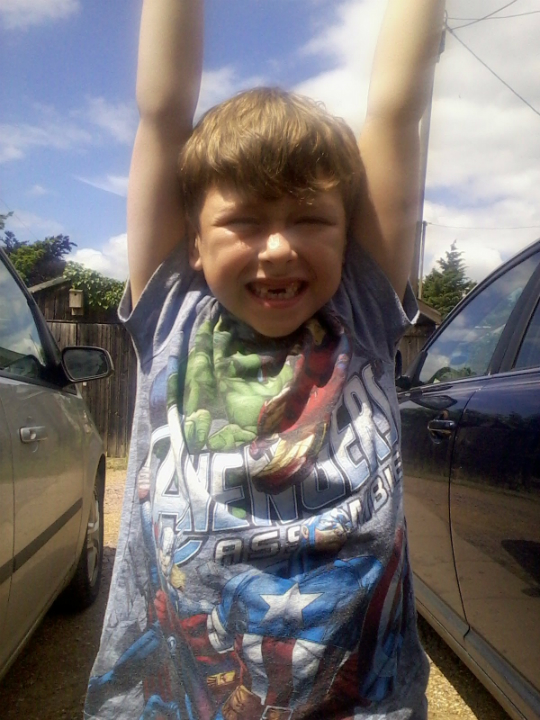 Mason's new smile.