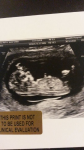 The first picture of our unborn child. The first picture of our unborn child.